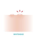 Whitehead acne vector illustration isolated on white background.