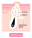 Whiteheads are types of acne pimples which are closed within the pore. Skin care concept