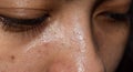 Whiteheads and pimples on oily face of Asian woman Royalty Free Stock Photo