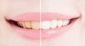 Whiten teeth after bleaching or whitening Royalty Free Stock Photo