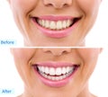 Whitening - bleaching treatment ,woman teeth and smile, before a Royalty Free Stock Photo