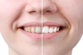 Whitening or bleaching treatment ,before and after ,woman teeth and smile, close up, isolated on white Royalty Free Stock Photo