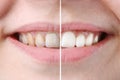 Whitening or bleaching treatment ,before and after ,woman teeth and smile, close up,  on white Royalty Free Stock Photo