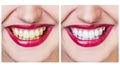 Whitening before and after