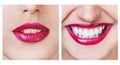 Whitening before and after