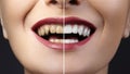 Before and after whitening treatment or dental veneers on teeth. Health Care collage of human mouth. Caries therapy