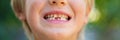 Wide view image of a toddler boys smile with missing milk teeth