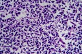 Wilms tumor, light micrograph Royalty Free Stock Photo