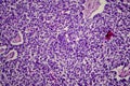 Wilms tumor, light micrograph Royalty Free Stock Photo