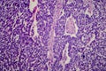 Wilms tumor, light micrograph Royalty Free Stock Photo