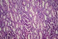 Wilms tumor, light micrograph Royalty Free Stock Photo