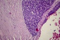 Wilms tumor, light micrograph Royalty Free Stock Photo
