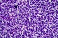 Wilms tumor, light micrograph Royalty Free Stock Photo