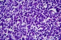 Wilms tumor, light micrograph Royalty Free Stock Photo