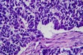 Wilms tumor, light micrograph Royalty Free Stock Photo