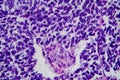 Wilms tumor, light micrograph Royalty Free Stock Photo