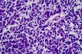 Wilms tumor, light micrograph Royalty Free Stock Photo