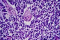 Wilms tumor, light micrograph Royalty Free Stock Photo