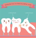 Wisdom Teeth Partial Eruption Impaction Royalty Free Stock Photo