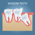 Wisdom teeth problems vector poster design template Royalty Free Stock Photo