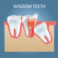 Wisdom teeth problems vector poster design template Royalty Free Stock Photo