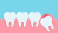 Wisdom teeth under the gums cause pain in the mouth. Dental care concept