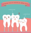 Wisdom Teeth Vertical Impaction