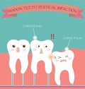 Wisdom Teeth Vertical Impaction Royalty Free Stock Photo