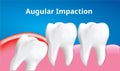 Wisdom tooth Angular or mesial impaction with inflammation affect , Dental concept, Realistic Vector