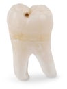 Wisdom Tooth with Cavity Royalty Free Stock Photo
