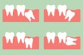 Wisdom tooth