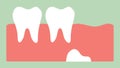 Wisdom tooth distal impaction