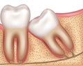 Wisdom tooth eruption diagram Royalty Free Stock Photo