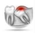 Wisdom tooth eruption inflamed gums
