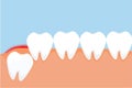 A wisdom tooth erupts through the gum and gives a red pain signal concept. Dangerous wisdom toothache causes gum pain vector.