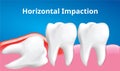 Wisdom tooth Horizontal impaction with inflammation affect , Dental care concept, Realistic Vector Royalty Free Stock Photo