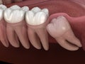 Wisdom tooth with impaction at molar tooth. Medically accurate tooth illustration