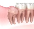 Wisdom tooth with impaction at molar tooth. Medically accurate tooth 3D illustration Royalty Free Stock Photo