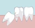 A wisdom tooth makes problem for molars in the gum, a vector stock illustration with adult jaw and teeth for orthodontic services