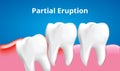 Wisdom tooth Partital Eruption with inflammation affect , Dental care concept, Realistic Vector