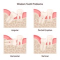 Wisdom tooth problems set. Impaction, wisdom teeth growing with wrong Royalty Free Stock Photo