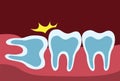 Wisdom tooth pushing adjacent teeth, wisdom tooth problem. teeth row and gum in x-ray cartoon flat illustration vector