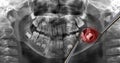 Wisdom tooth, x-ray dental scan Royalty Free Stock Photo