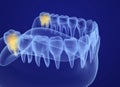 Wisdom tooth xray view. Medically accurate tooth illustration