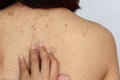 Woman with Acne on the back