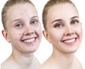 Woman with acne before and after treatment and make-up