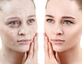 Woman with acne before and after treatment and make-up.