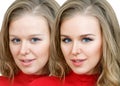 Woman with acne before and after treatment and makeup. Royalty Free Stock Photo