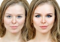 Woman with acne before and after treatment and makeup. Royalty Free Stock Photo