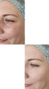 Woman adult face wrinkles before after beautician regeneration treatment rejuvenation collage correction